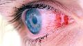Препараты при аллергическом воспалении глаз